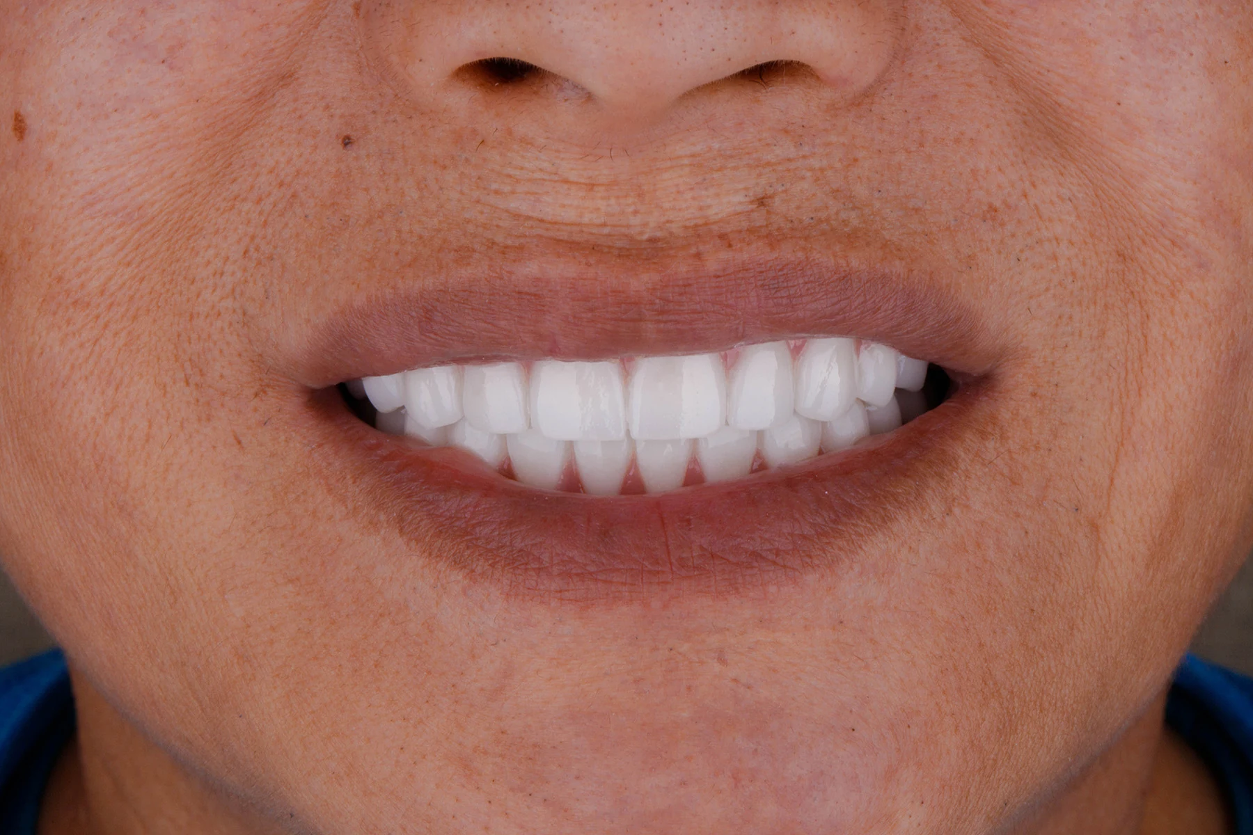 After treatment — Cosmetic dentistry patient transformation