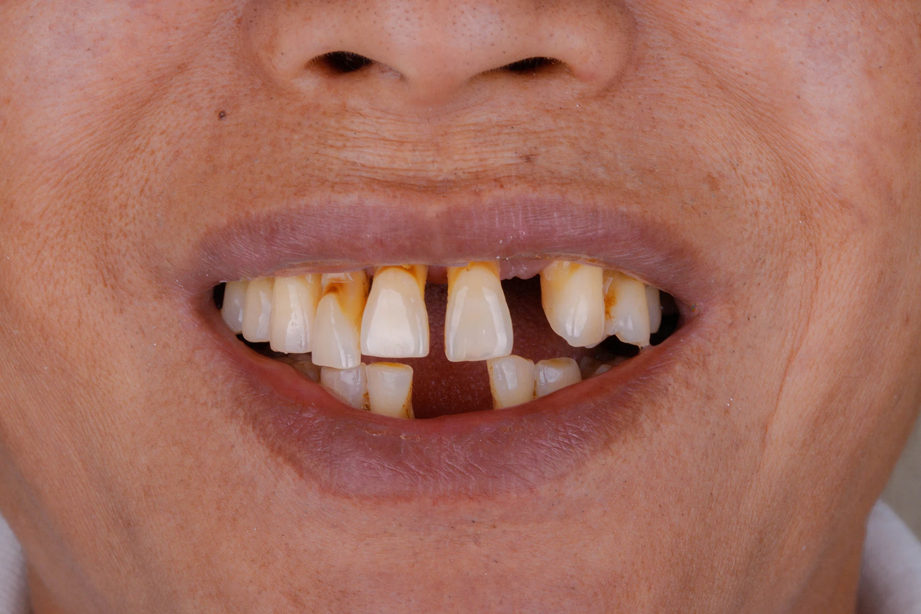 Before treatment — Cosmetic dentistry patient transformation