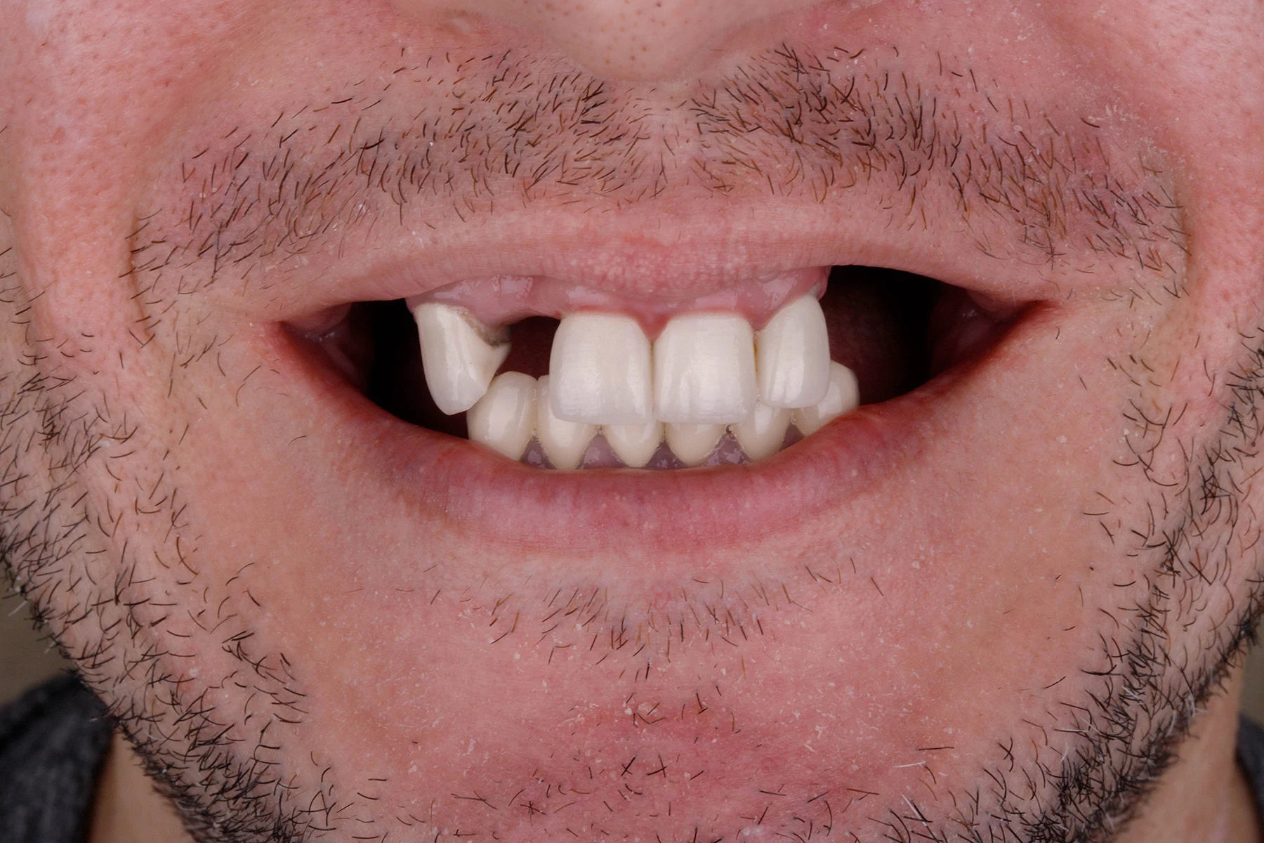 Before treatment — Single dental implant patient transformation