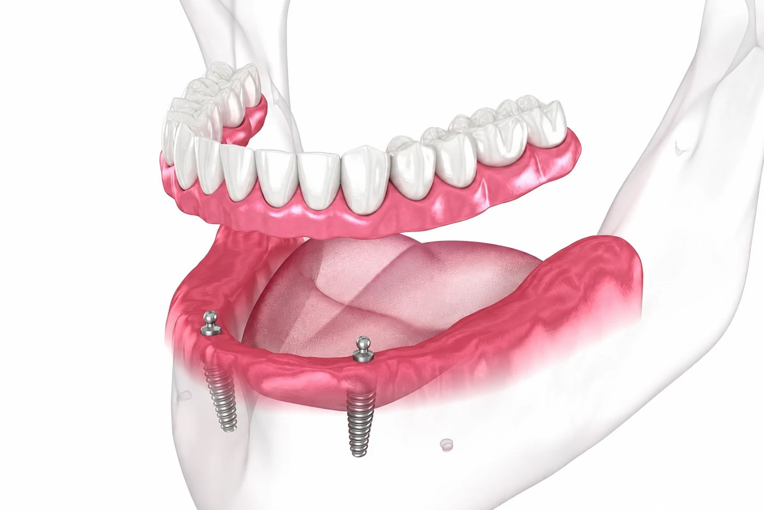 Clinical illustration of a ball-retained implant overdenture snapping onto dental implants