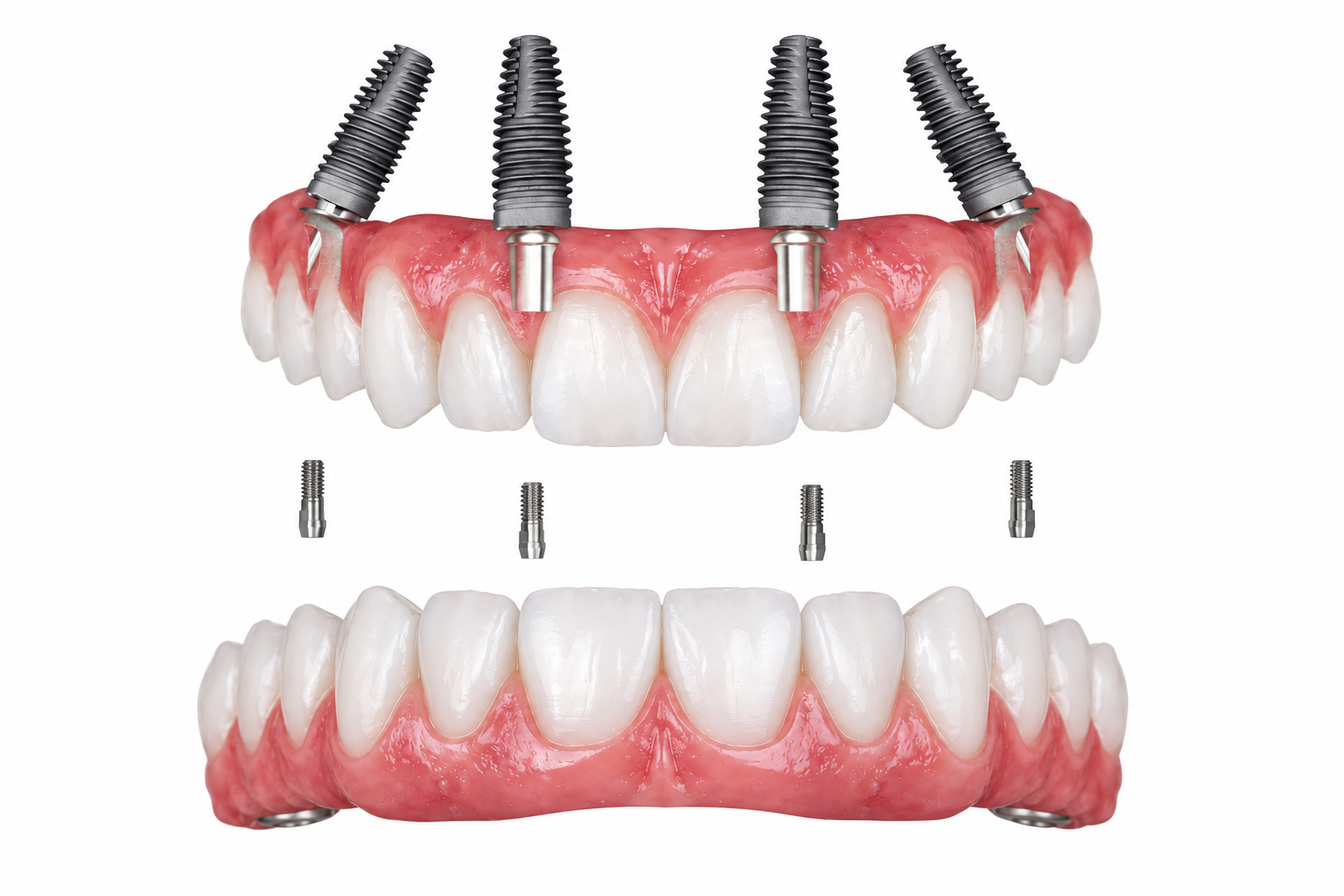 Clinical illustration of a fixed full-arch restoration supported by dental implants