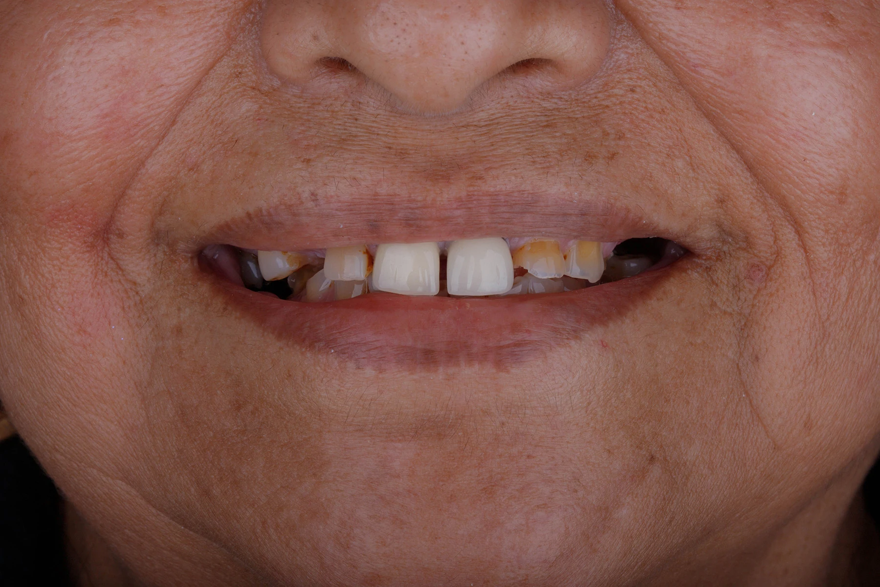 Before treatment — Implant-supported denture patient transformation