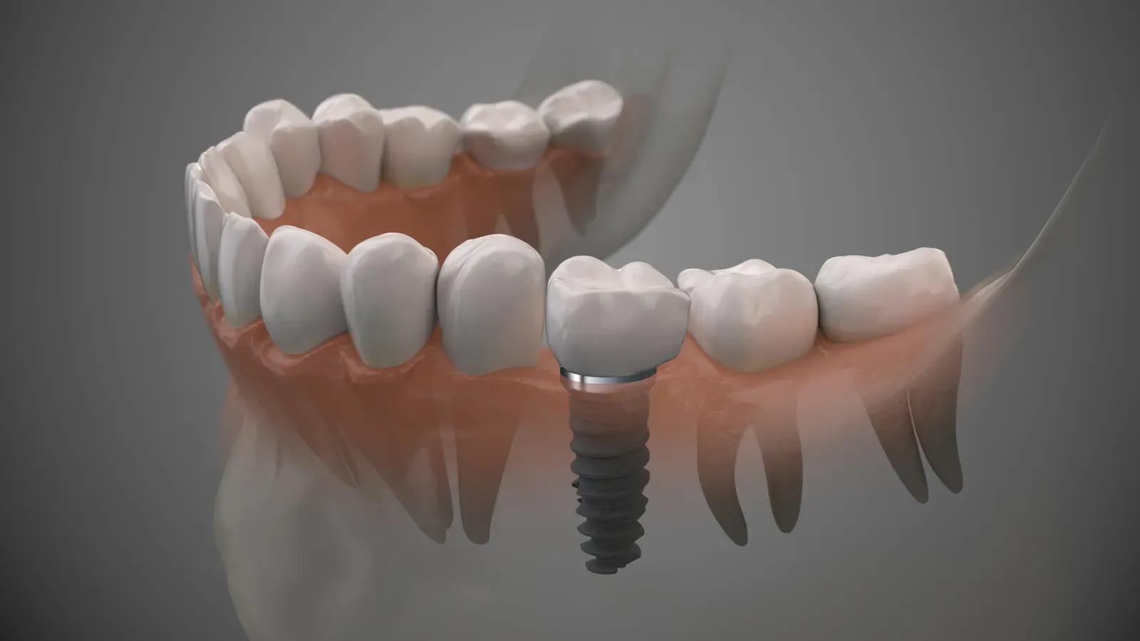 Illustration of a single dental implant with crown placed in the jawbone