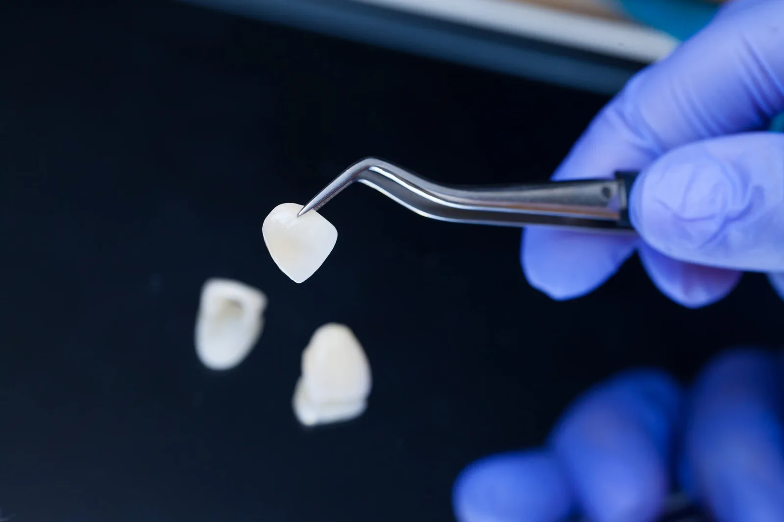 Veneers vs Bonding: Which Cosmetic Treatment Is Best? — Samuel F. Jirik DDS, Cabot, Arkansas