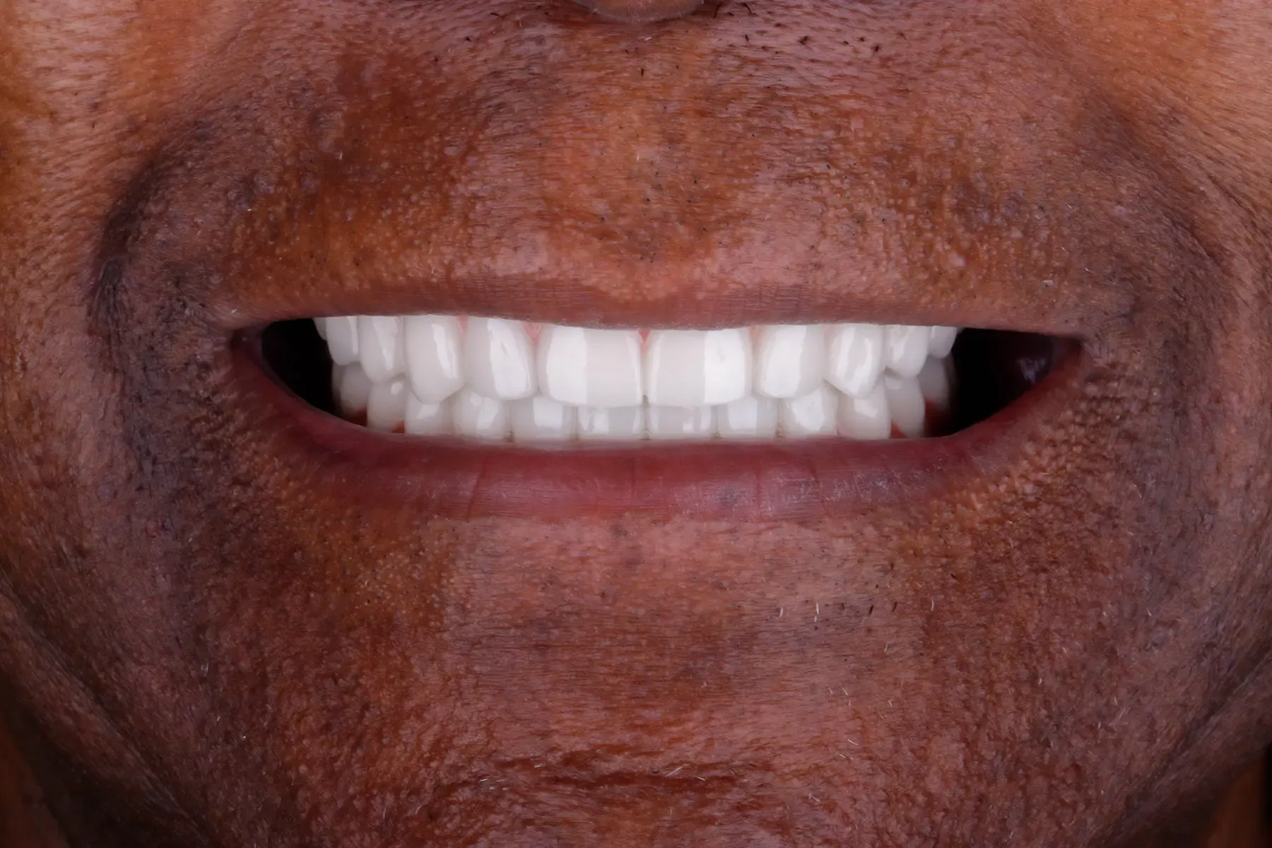 After treatment — Smile makeover for worn, discolored teeth