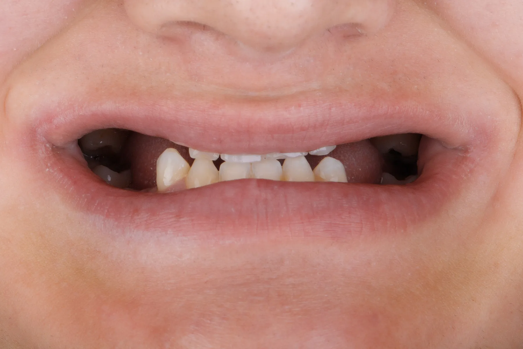Before treatment — Full-arch restoration of a compromised upper arch