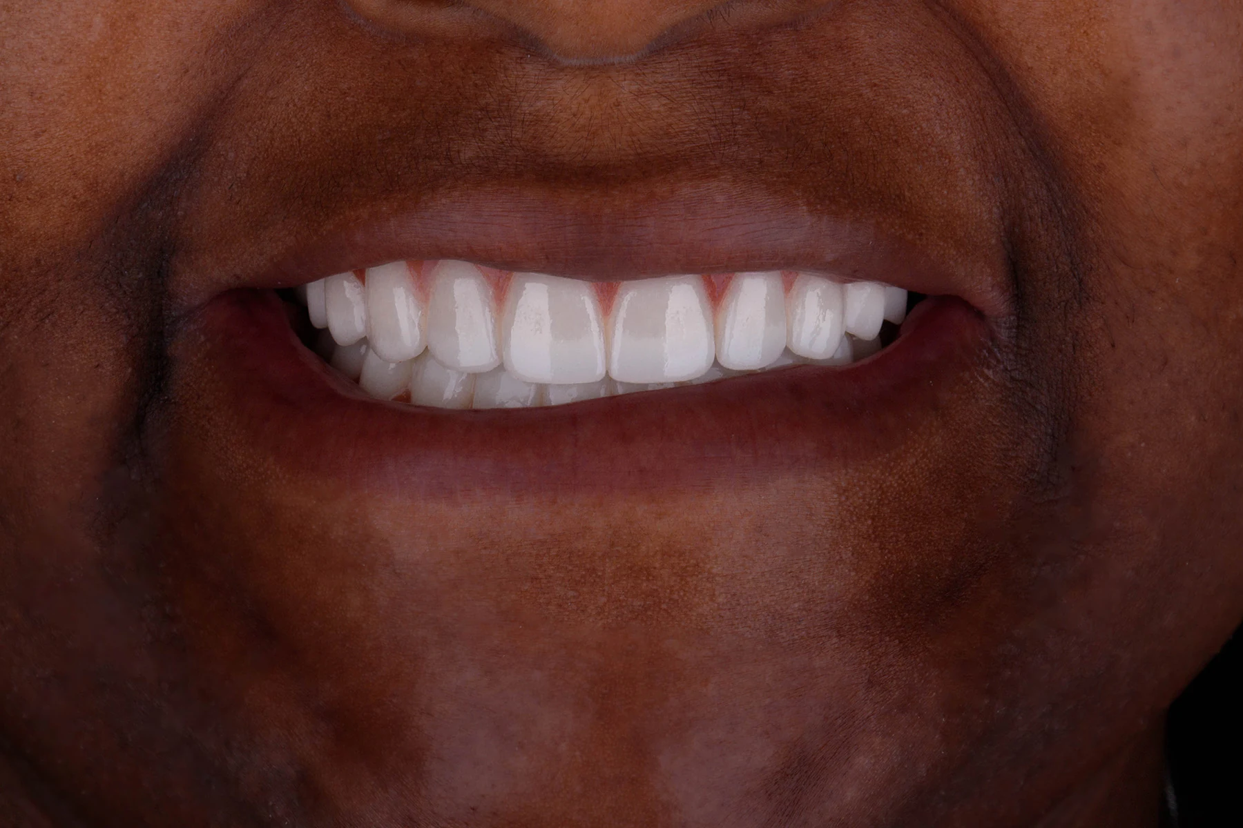 After treatment — Cosmetic dentistry patient transformation