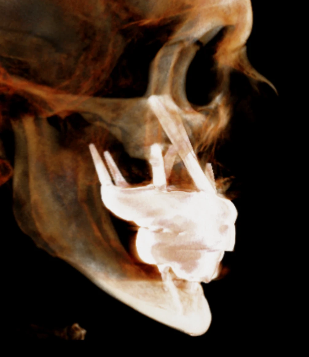 Clinical illustration of Zygomatic implants anchored in the cheekbone