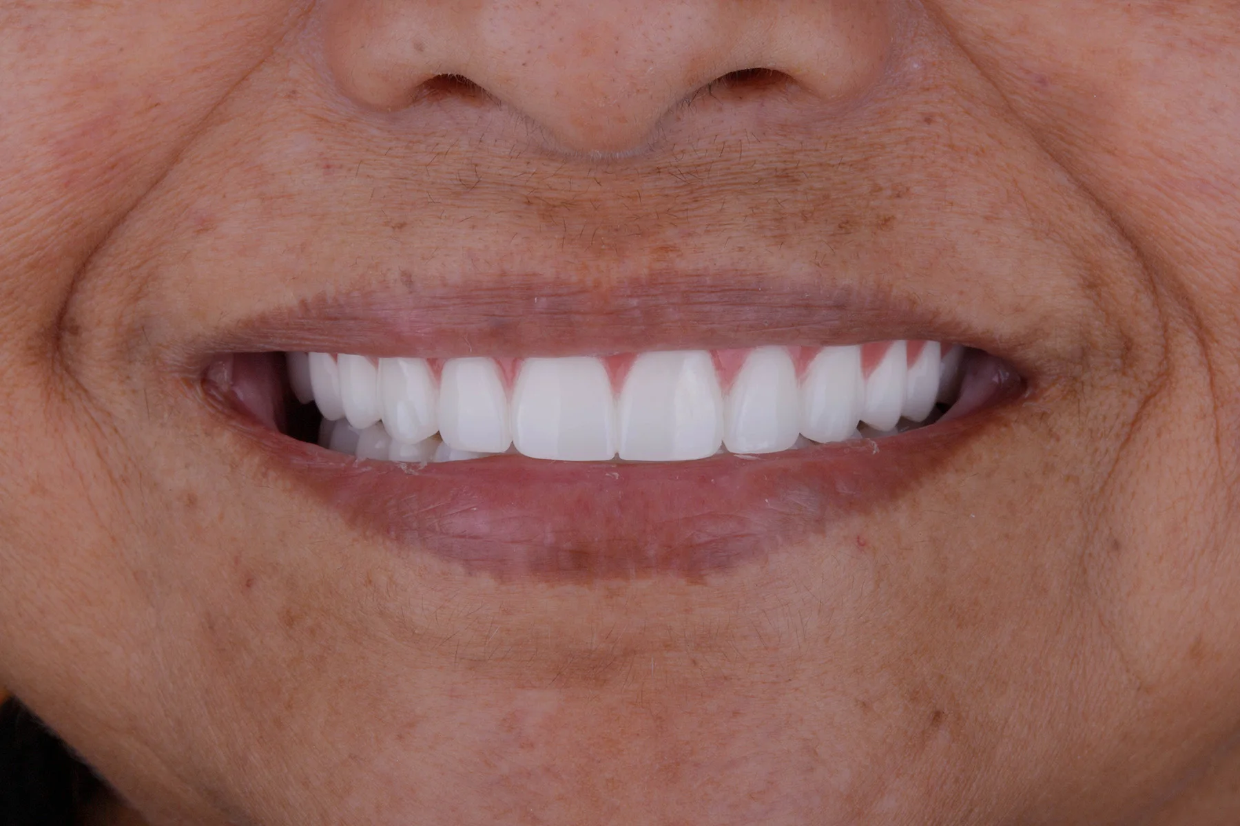After treatment — Veneer restoration of a worn, spaced smile