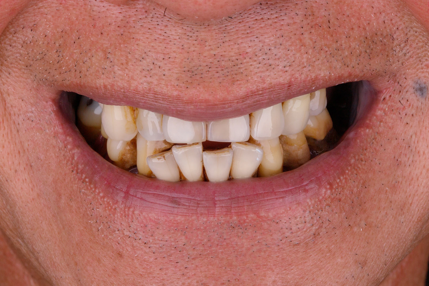 Before treatment — Veneers patient transformation