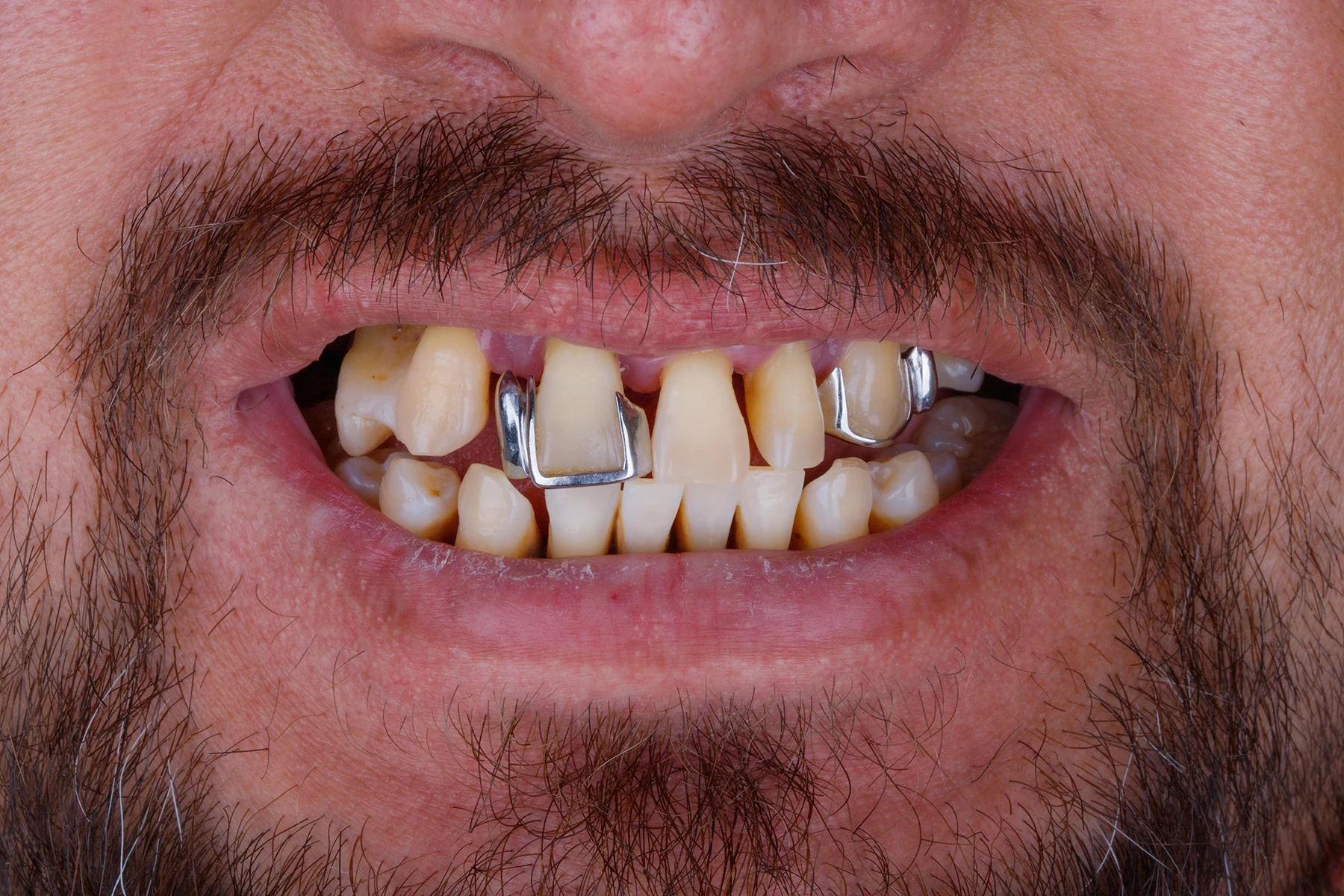 Before treatment — Veneers patient transformation