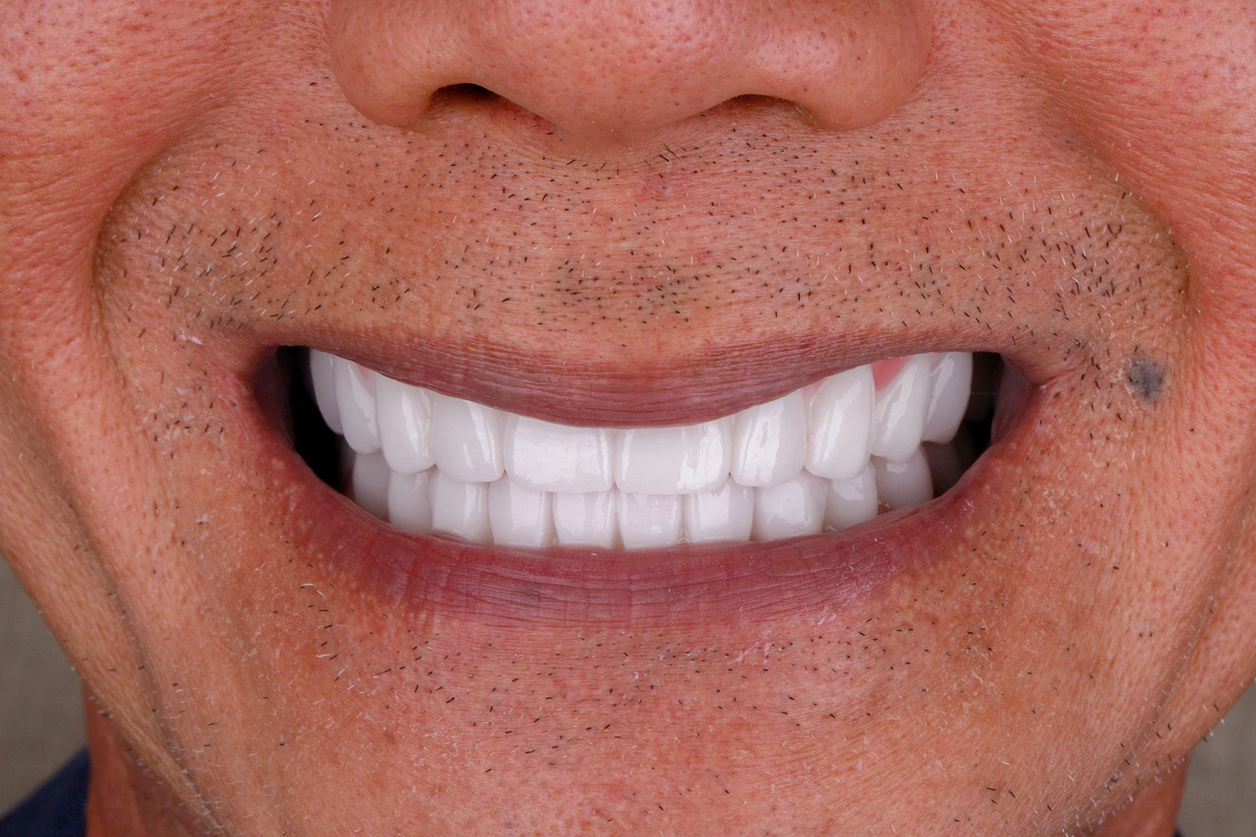 After treatment — Veneers patient transformation