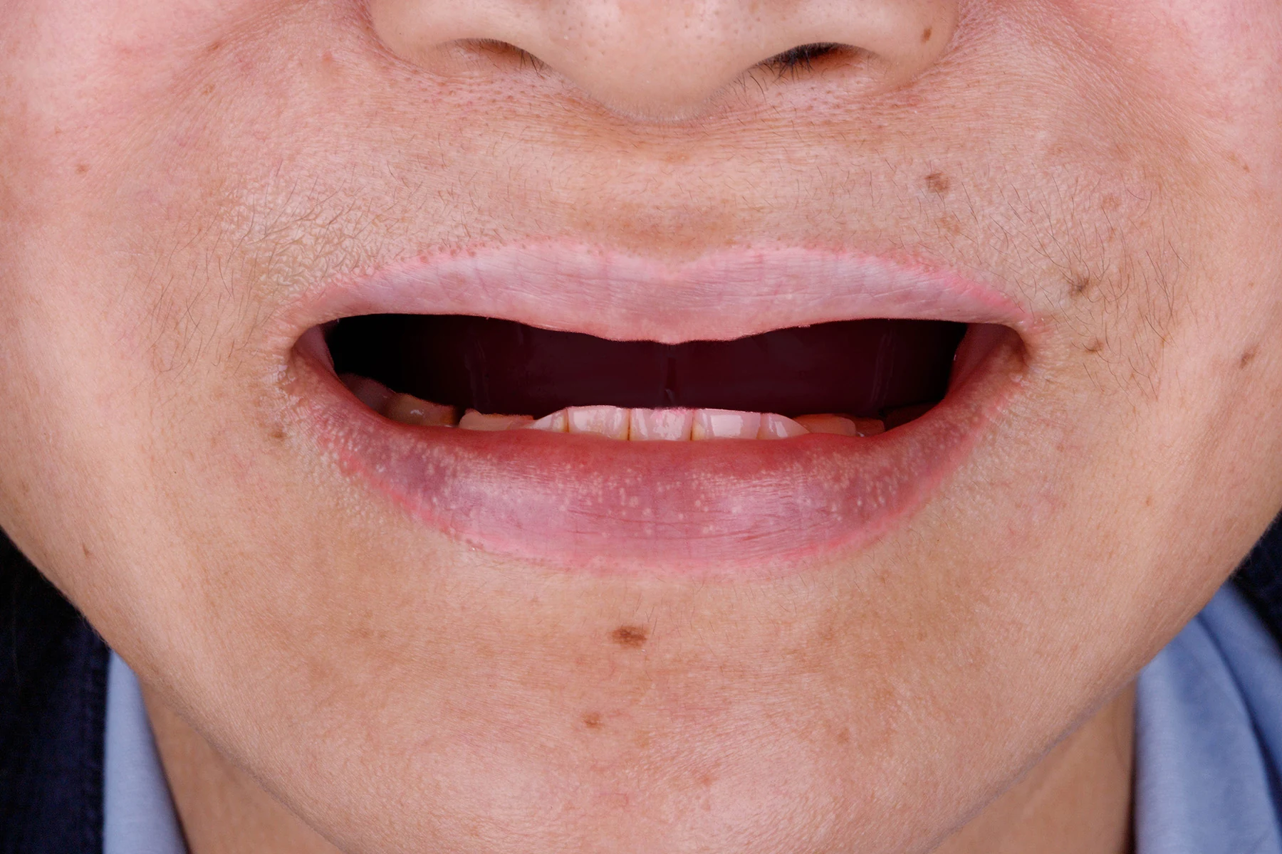 Before treatment — Implant-supported denture patient transformation