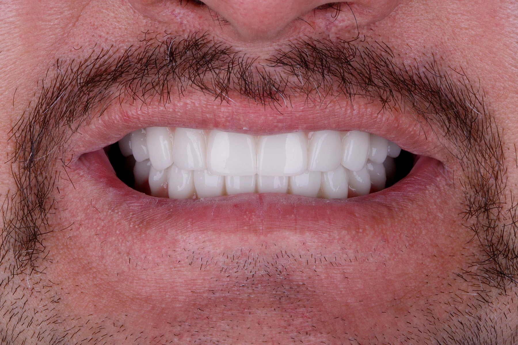 After treatment — All-on-4 patient transformation