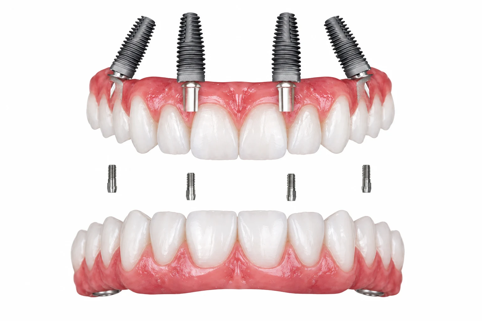 Illustration of a full-arch implant restoration supported by dental implants