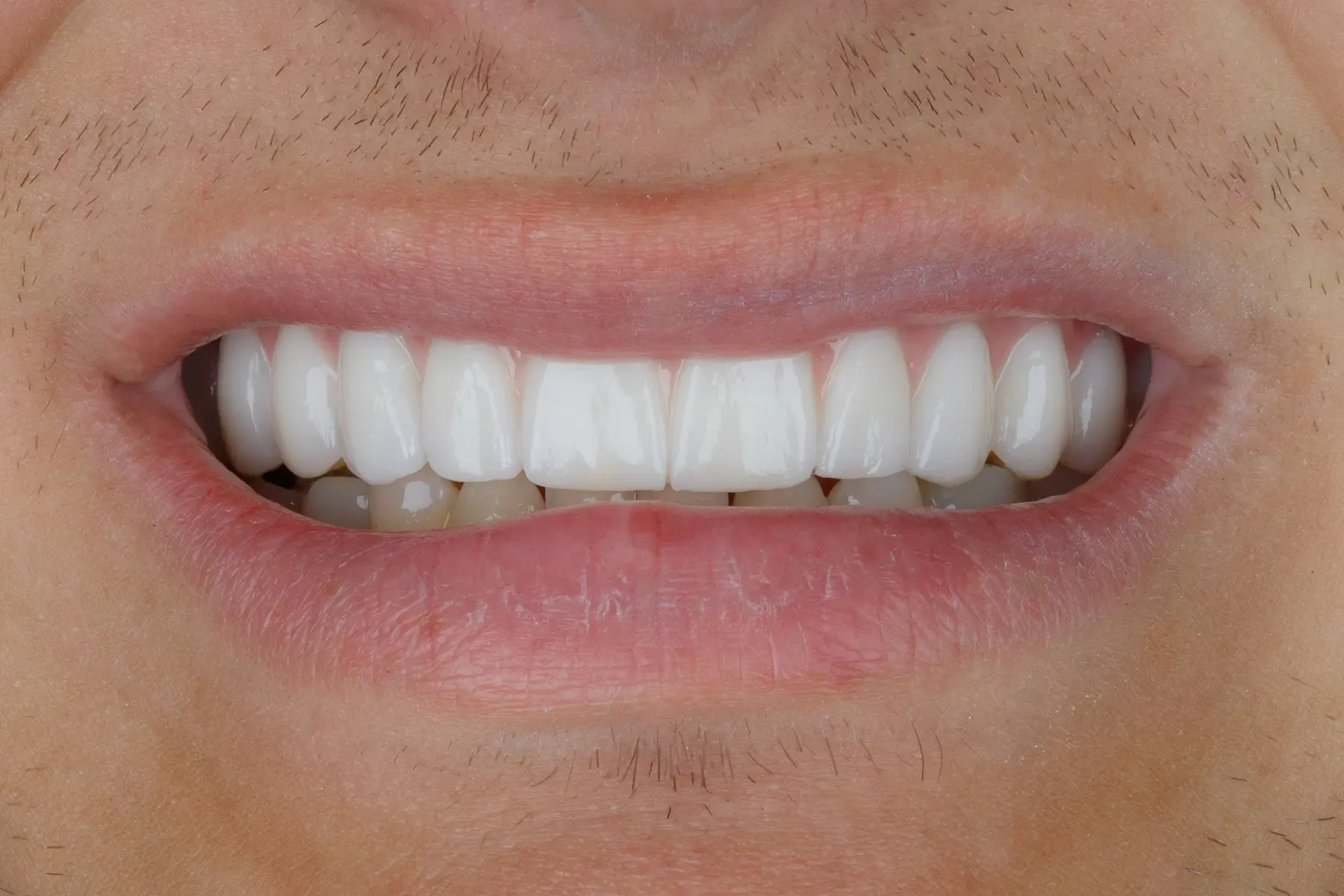 After treatment — Full-arch restoration of a compromised upper arch
