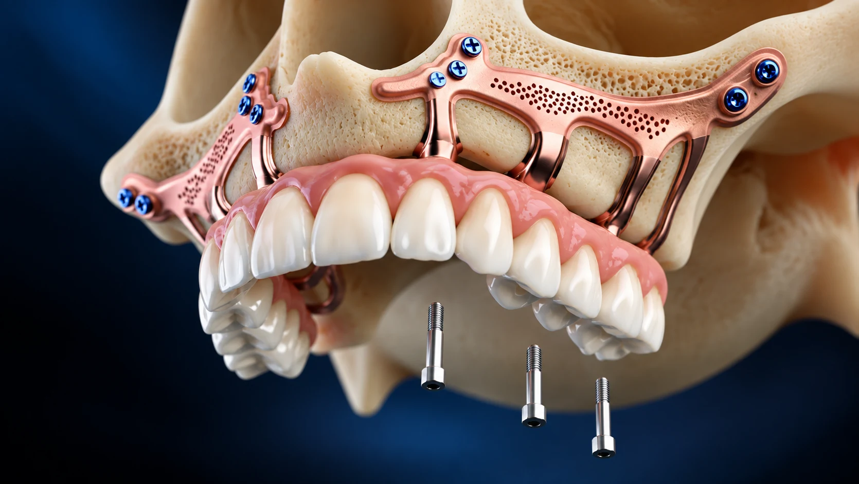 Clinical illustration of a Subperiosteal implant — a custom-made titanium frame resting on top of the jawbone beneath the gum tissue, supporting a fixed set of replacement teeth