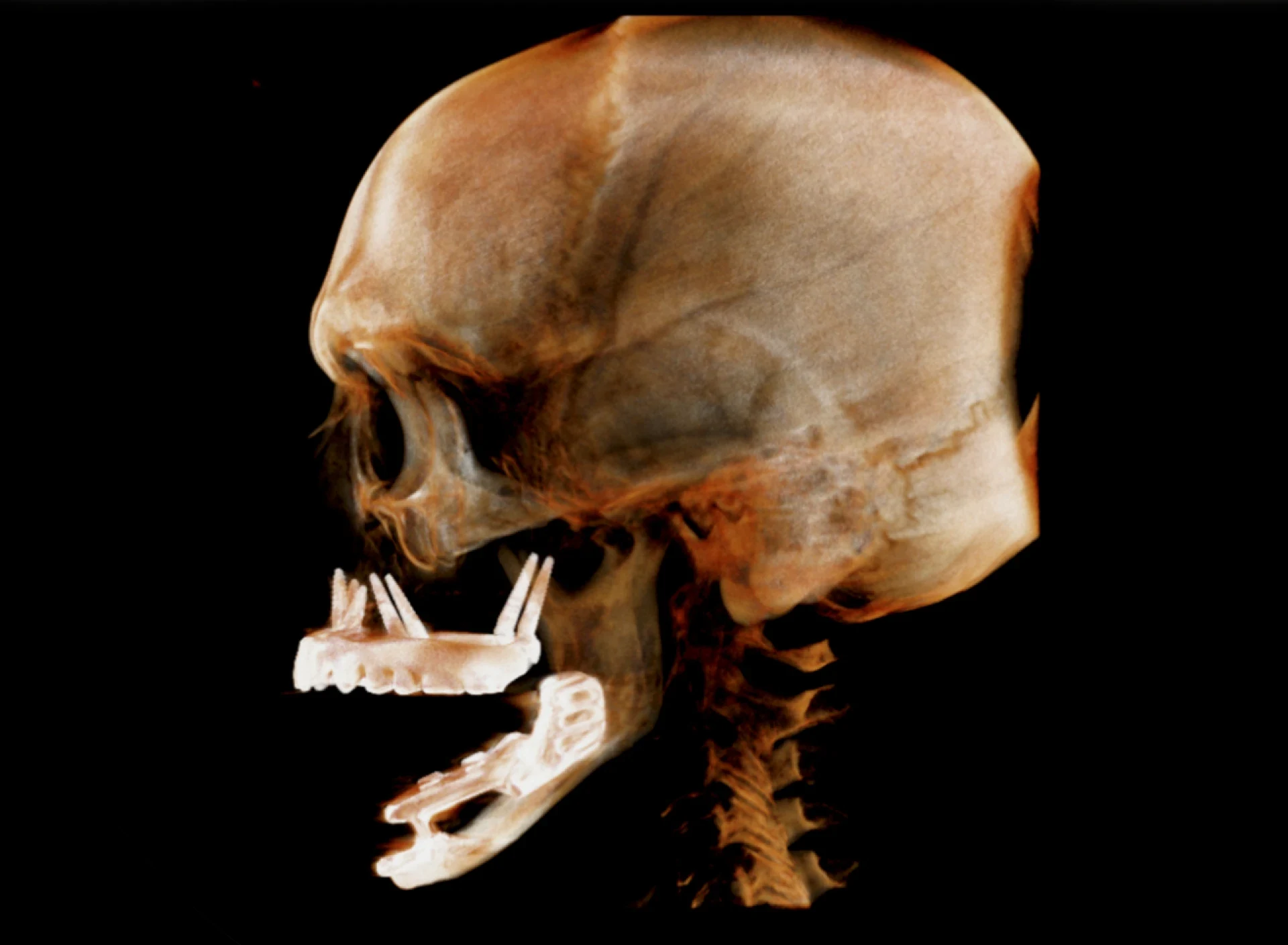 Three-dimensional scan rendering of a skull facing left, showing a full upper arch of replacement teeth supported by implants anchored in the cheekbone, and implants placed along the lower jaw