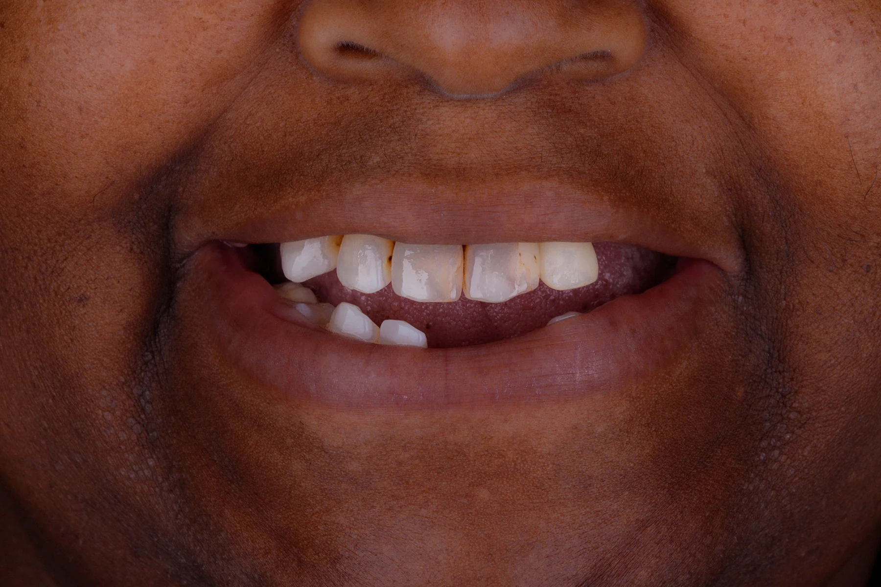 Before treatment — Smile makeover patient transformation