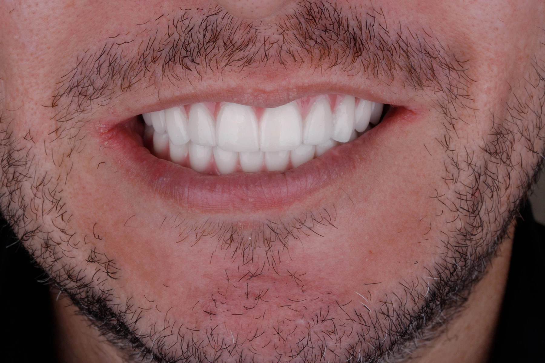 After treatment — Single dental implant patient transformation