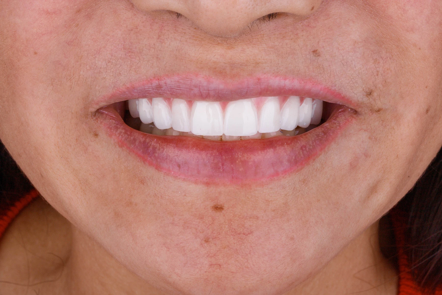 After treatment — Implant-supported denture patient transformation