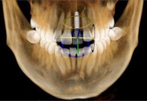 ct scan x-ray of human teeth with upper central incisor implant
