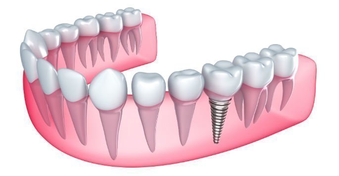 replace missing teeth with dental implants 5e042c3f4022f