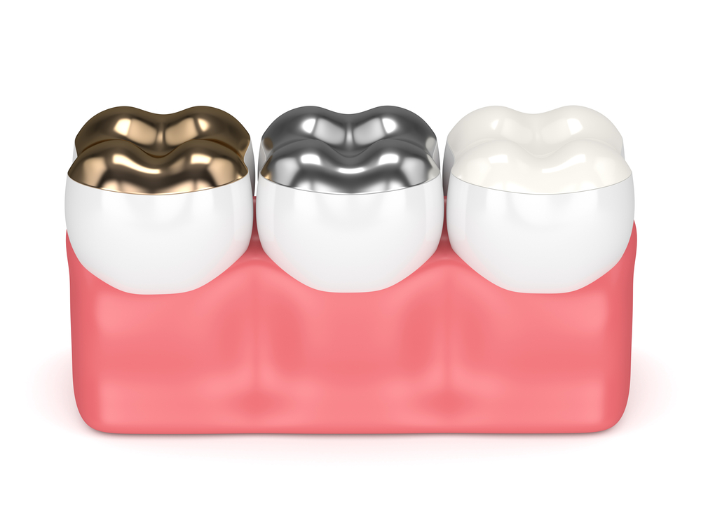 9 Top Benefits of Dental Crowns - Samuel F. Jirik, DDS
